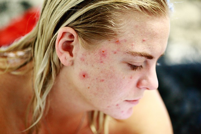 10 Best Essential Oils for Pimples